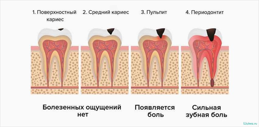 Кариес зуба: лечение в зубной клинике