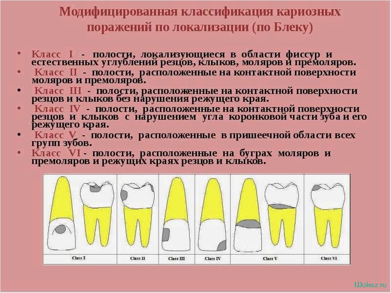 Кариес зуба: лечение в зубной клинике